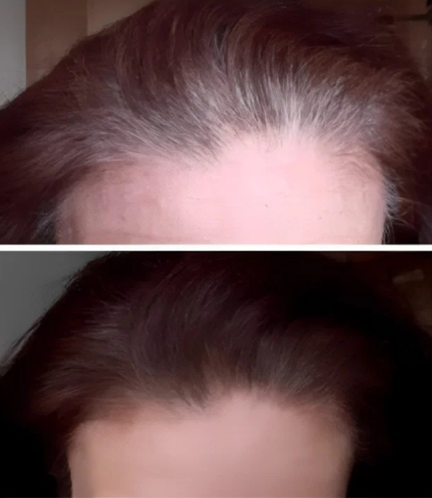 Comparação ilustrativa da linha de cabelo antes e depois do uso de fibra capilar