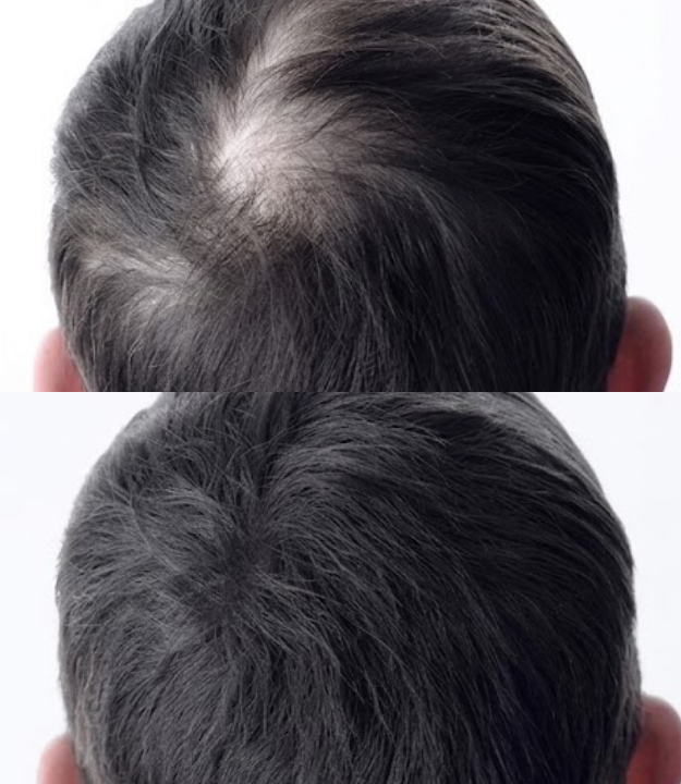 Comparação ilustrativa do topo da cabeça antes e depois do uso de fibra capilar