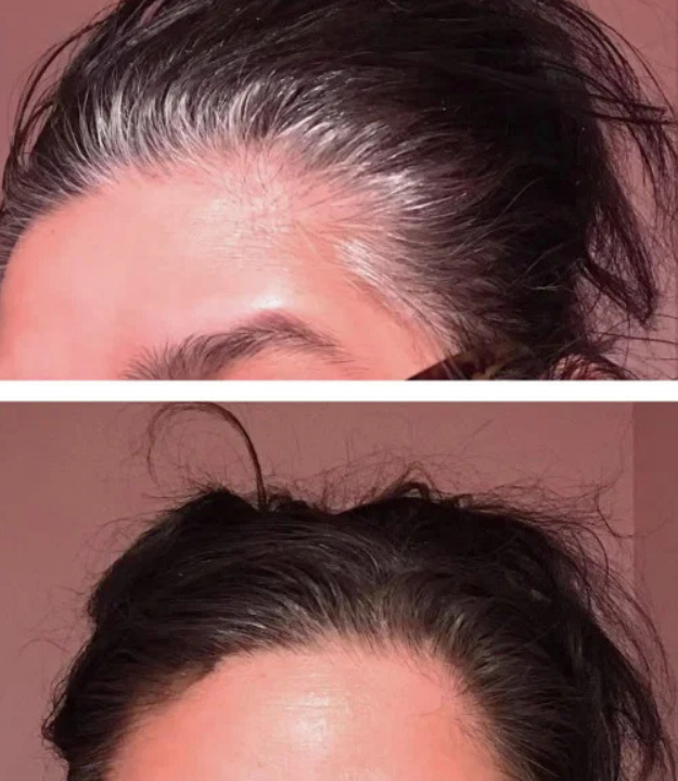 Comparação ilustrativa da linha de cabelo antes e depois do uso de fibra capilar