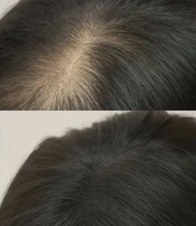 Comparação ilustrativa do topo da cabeça antes e depois do uso de fibra capilar